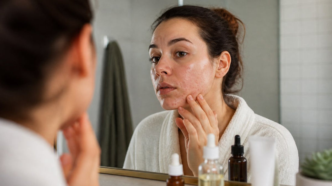 Retinol Purging: What It Is and How Long It Lasts
